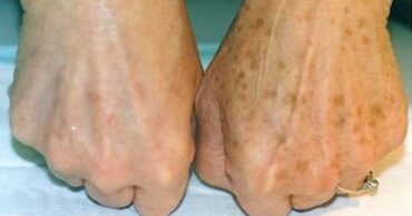 Uklonite staračke pege sa ruku (RECEPT)