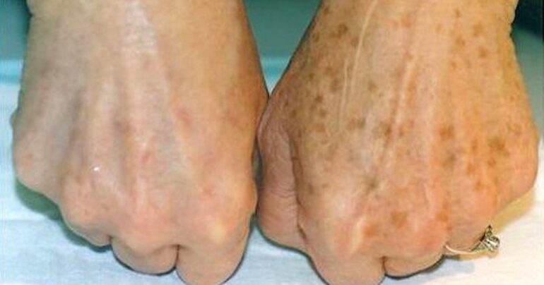 Uklonite staračke pege sa ruku (RECEPT)