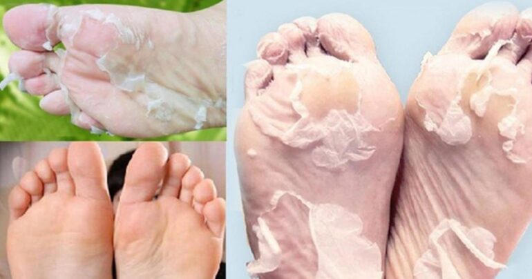 Kompletno uklanjanje pukotina, žuljeva! Suva i gruba koža nije dobra…