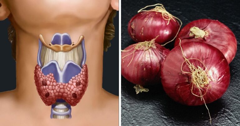 Izlečite štitnu žlezdu sa oblogama od luka