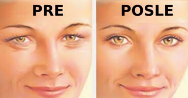 Kako zategnuti opuštenu kožu kapaka: 4 jednostavna koraka!