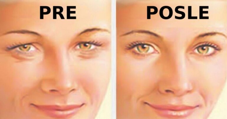 Kako zategnuti opuštenu kožu kapaka: 4 jednostavna koraka!