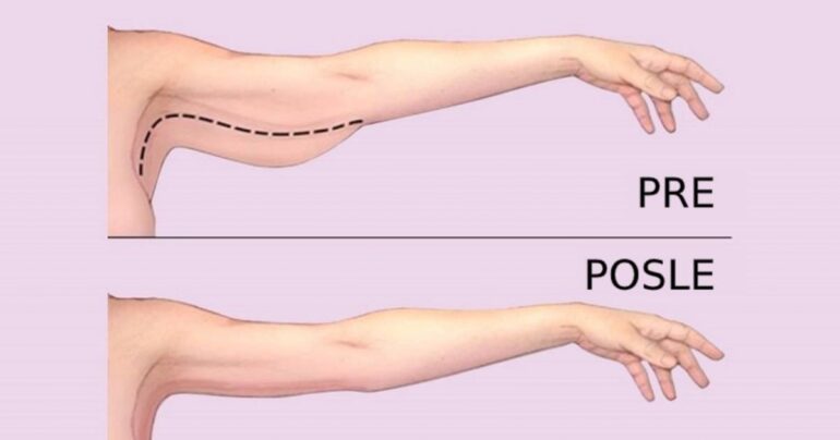 Kako se otarasiti mlitavih ruku: 3 efikasna načina!