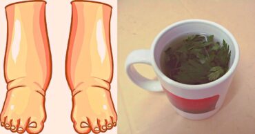 OTICANJE NOGU: Ovo je najmoćniji prirodni lek za otečene noge!