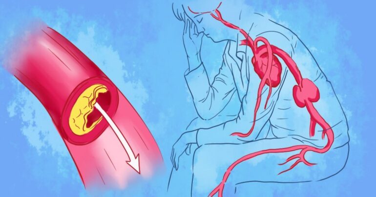 10 superhrana za efikasno čišćenje arterija i prevenciju srčanog udara!