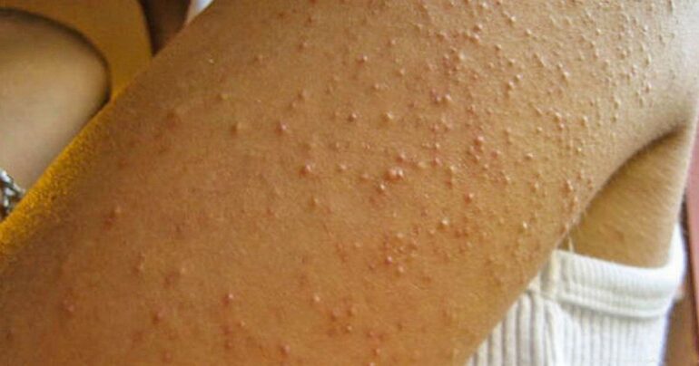 Nije imala pojma odakle joj neobičan osip na rukama… Upozoravajući znaci ozbiljne bolesti