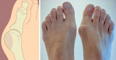 Kako izlečiti giht na brz i prirodan način