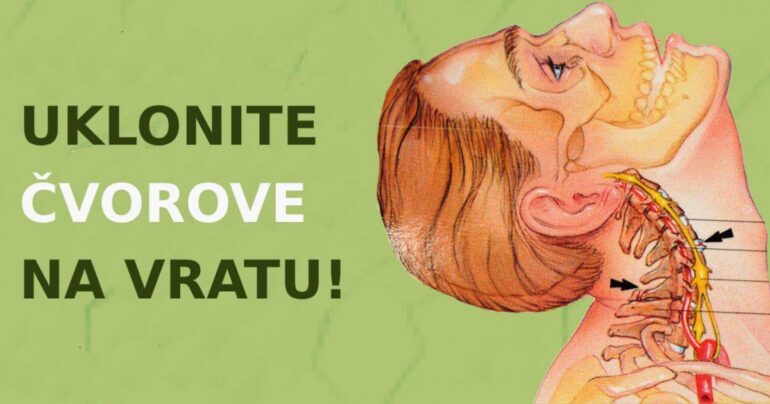 Evo kako ukloniti čvorove na vratu! Оzbiljan problem se može rešiti!