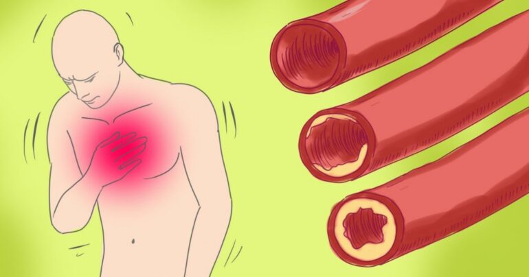 Čišćenje krvnih sudova bez tableta: Pritisak će uvek biti 120 sa 80!