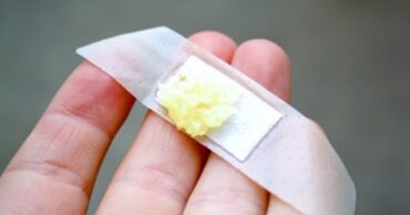 Uputstvo kako ukloniti bradavice prirodnim putem