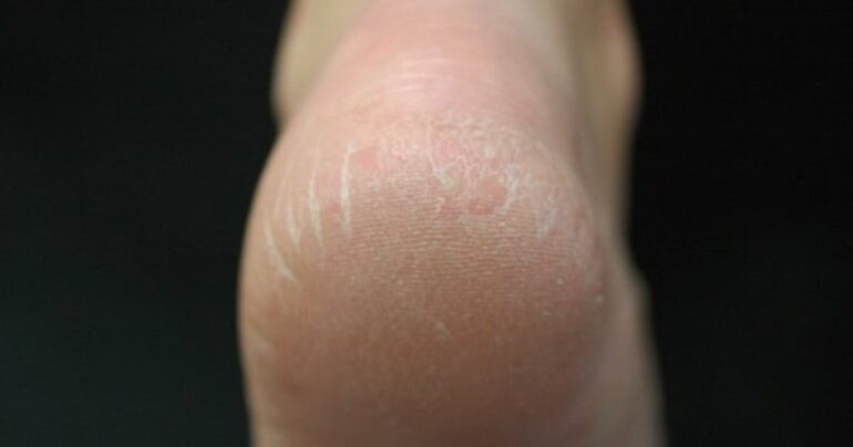 Pete meke kao bebine: Zaboravite na ispucale i suve pete!