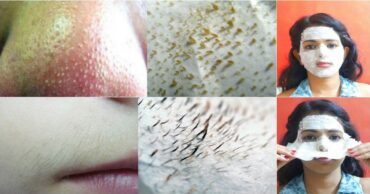 Mitiseri na nosu nestaju 100%! Čudesna maska!