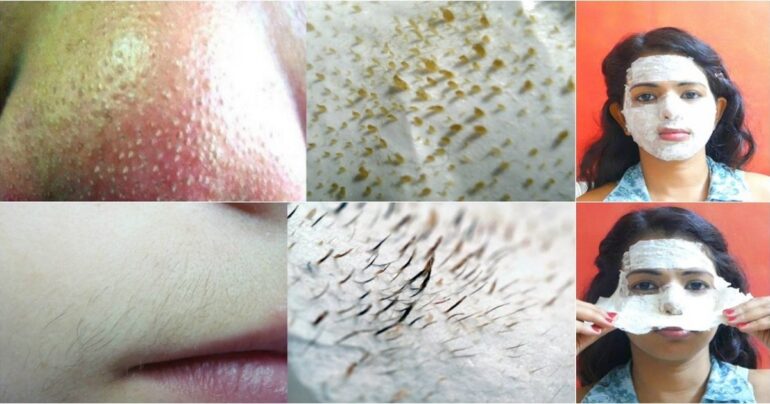 Mitiseri na nosu nestaju 100%! Čudesna maska!