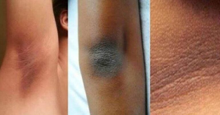 Vodič za uklanjanje tamnih fleka na vratu, laktovima, kolenima i ispod pazuha!