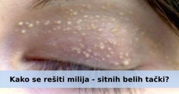 Kako se rešiti milija – sitnih belih tački oko očiju?