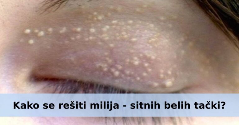 Kako se rešiti milija – sitnih belih tački oko očiju?