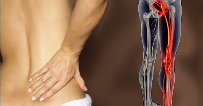 Kako otklještiti uklješteni nerv u lumbalnom delu (išijas): 2 jednostavna načina osloboditi se bola