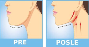Samo 5 jednostavnih vežbi koje će vas rešiti podbradka! Zagarantovan uspeh