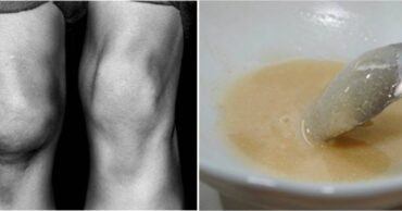 Domaća mast protiv bolova u kolenima i zglobovima. Pomaže već nakon nekoliko dana!