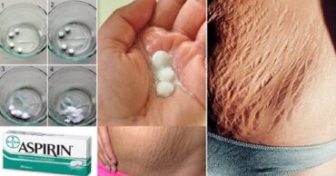 Imate strije? Izvolite najefikasniji recept za njihovo uklanjanje