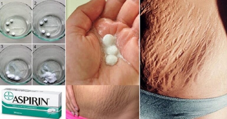 Imate strije? Izvolite najefikasniji recept za njihovo uklanjanje