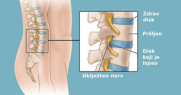Diskus hernija – Hirurg me odvratio od operacije, savetujući mi da uradim OVE vežbe … Šest meseci kasnije, rezultat!