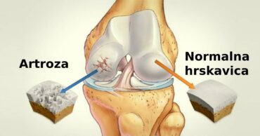 Podmladite zglobove kao sa 20 godina! Kako za 2 nedelje ojačati globove!