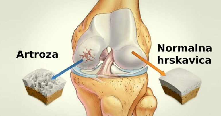 Podmladite zglobove kao sa 20 godina! Kako za 2 nedelje ojačati globove!
