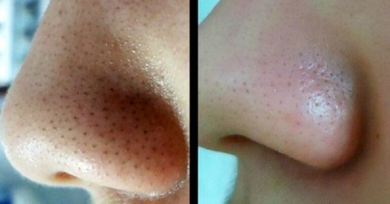 Čišćenje mitesera postalo je lako! Blistava koža nakon 7 dana!