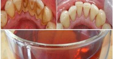 Kako se trajno otarasiti kamenca bez zubara. Ovaj efikasan lek će pomoći!