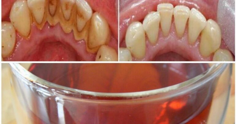 Kako se trajno otarasiti kamenca bez zubara. Ovaj efikasan lek će pomoći!