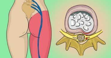 Jedna jednostavna vežba za ublažavanje bola išijasnog nerva