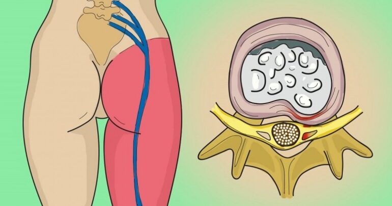 Jedna jednostavna vežba za ublažavanje bola išijasnog nerva