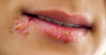 7 popularnih metoda koje će vam pomoći da se rešite herpesa!