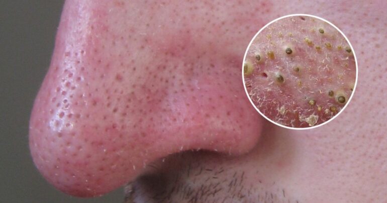 Rešite se odmah tih gadnih mitesera! A evo kako se to radi…