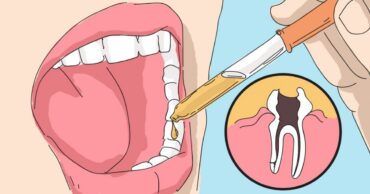 Pokušao sam sve, ali samo je ovo pomoglo… Samo sam ga naneo na zub i bol je odmah nestao!