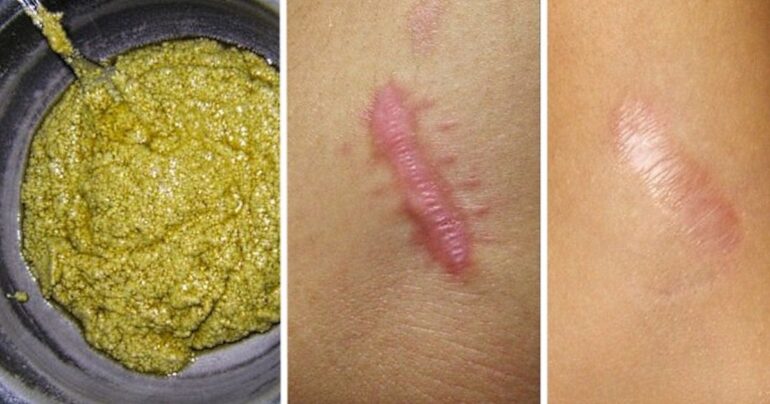 Kako se rešiti ožiljaka i strija za samo 2 meseca!