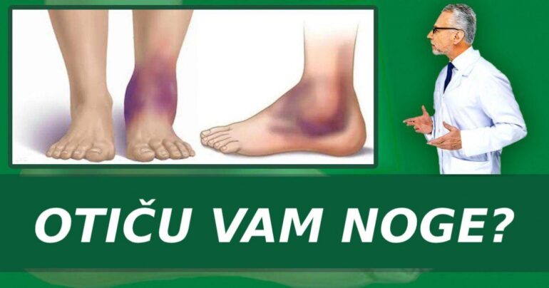 7 načina da se rešite edema (otoka tela)