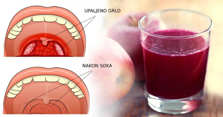 Narodni lek za lečenje bilo koje upale grla – sok od cvekle