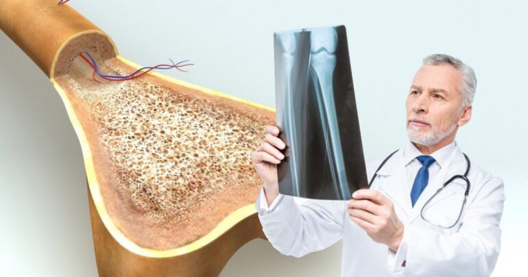 Krhke kosti: kako prepoznati i pobediti osteoporozu. Veoma je važno zadržati kalcijum…