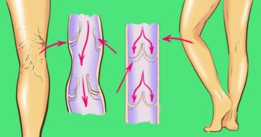 Sprečite pojavu proširenih vena kod žena i muškaraca