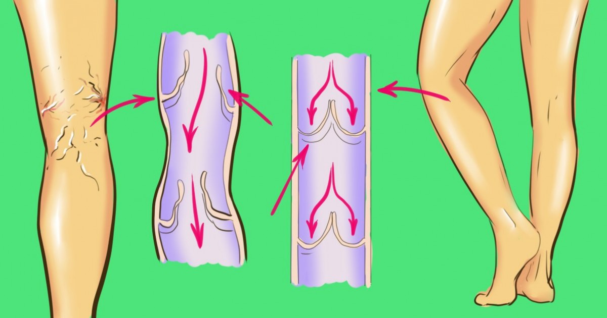 Sprečite pojavu proširenih vena kod žena i muškaraca