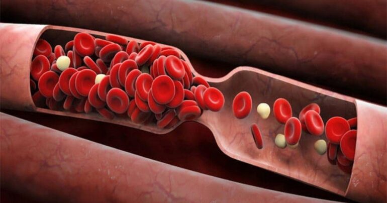 Gusta krv znači srčani udar, moždani udar i druge bolesti. Evo kako to izlečiti