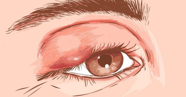 Kako se otarasiti čmička na oku